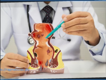 O Que É uma Hemorroida Externa Grau 1?